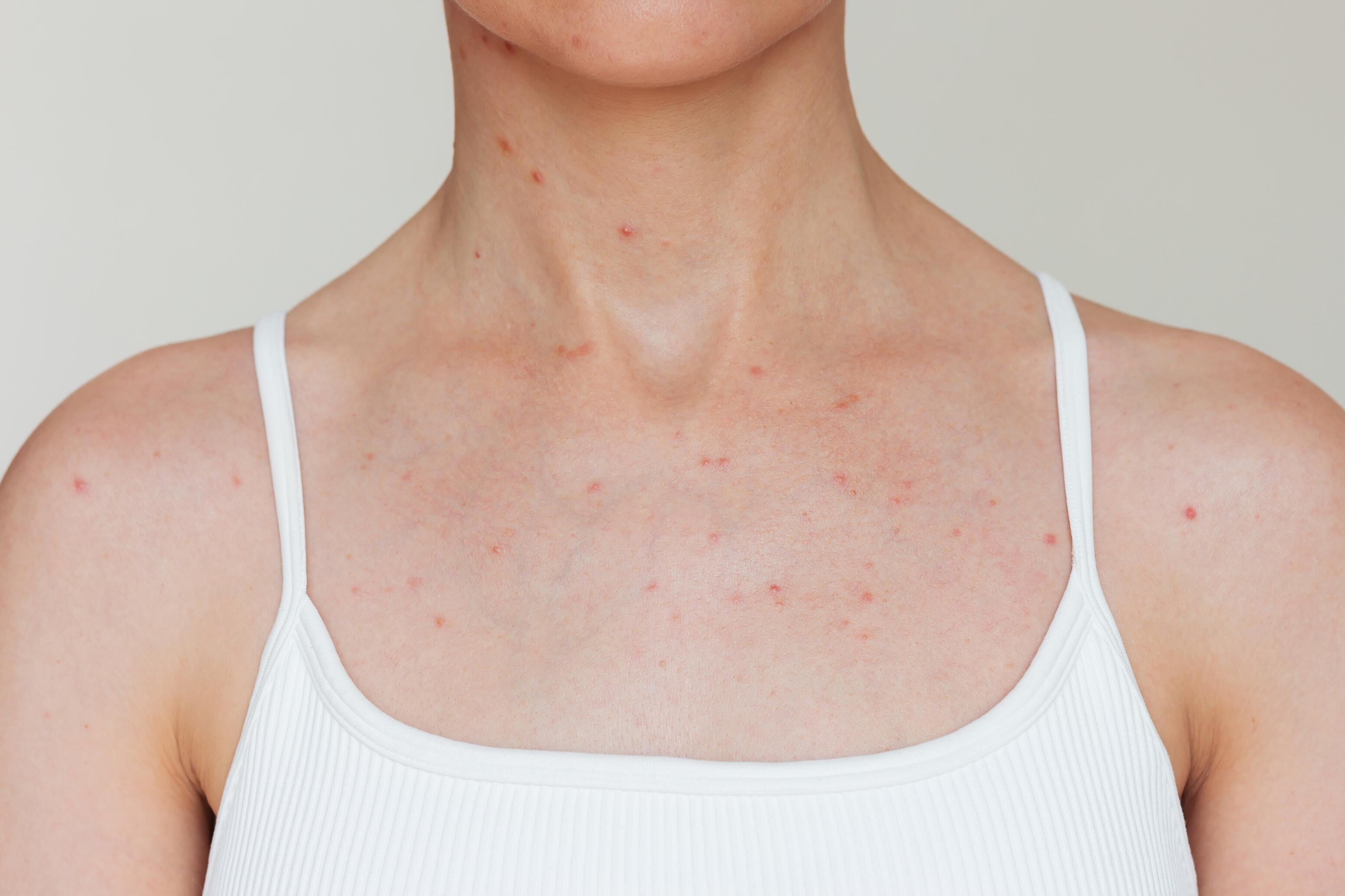 Acné du corps : dos, poitrine, torse – causes et solutions